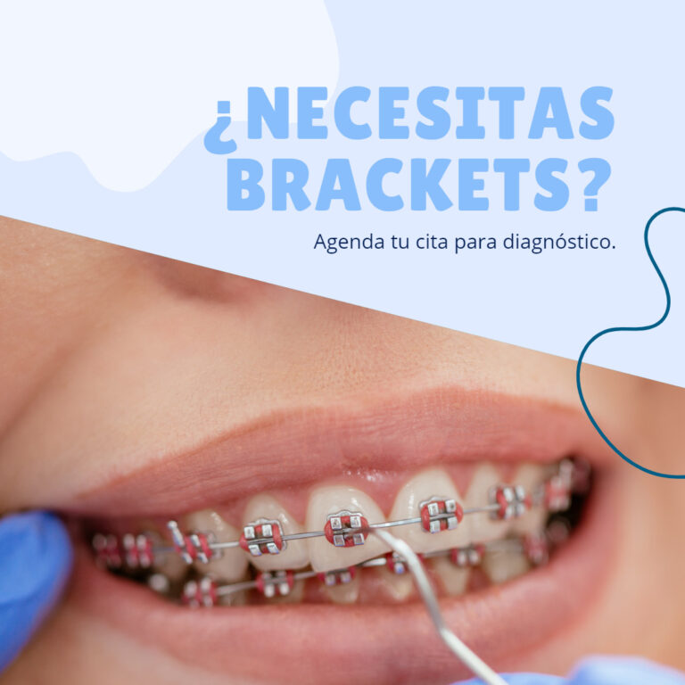 ¿Necesitas Brackets?